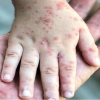 شناسایی ۹۸ بیمار مبتلا به سرخک در ایران/ضرورت واکسیناسیون کودکان زیر ۵ سال