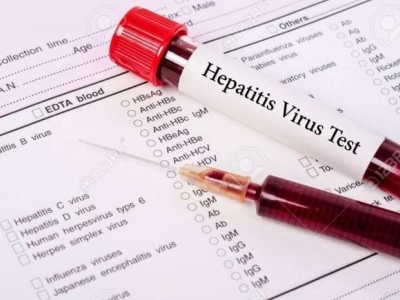 شناسایی ۷۲۷ بیمار مبتلا به هپاتیت در کشور 