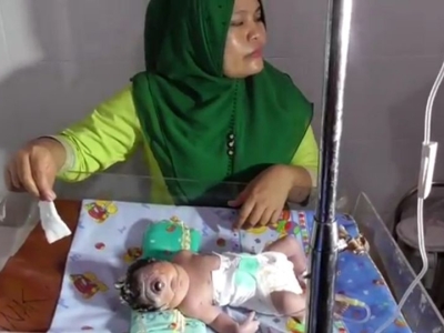 تولد نوزاد یک چشم در اندونزی+فیلم
