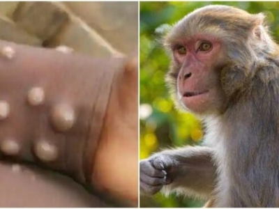 شناسایی اولین مورد ابتلا به ویروس آبله میمون در هندوستان