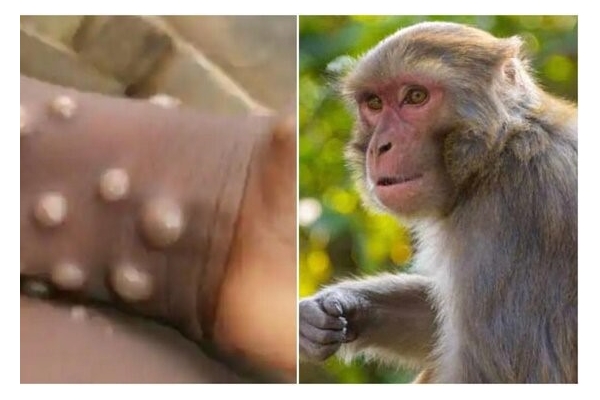 اقدام احتیاطیِ نیجریه برای مهار آبله میمونی
