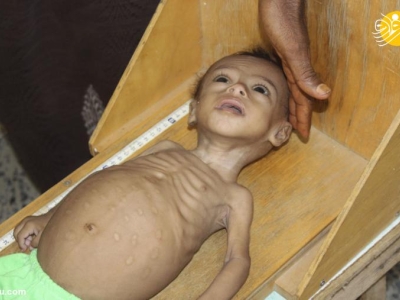  سوءتغذیه شدید کودک یمنی+ تصویر