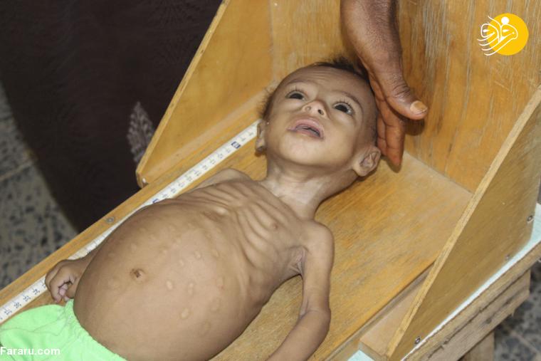 هشدار سازمان ملل: آمار قربانیان گرسنگی در جهان ۱۰ برابر شده است